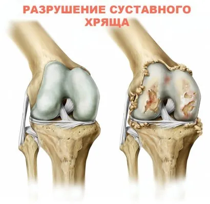 Разрушение хряща при артрозе