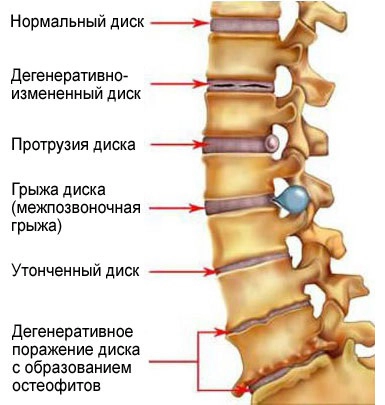 Причины боли в пояснице