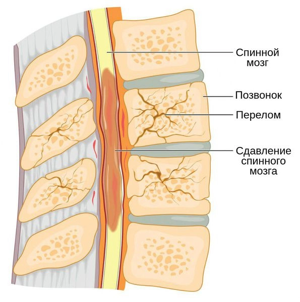 Как выглядит компрессионный перелом