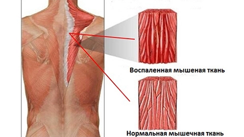 Изменение мышц при миозите