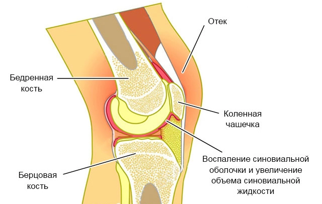 Воспаление в коленном суставе