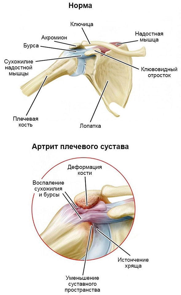 Плечевой сустав в норме и при артрите