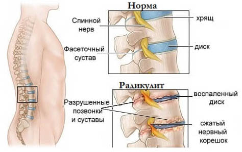 Осложнения радикулита