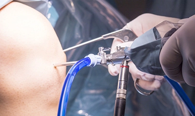 Процедура артроскопии